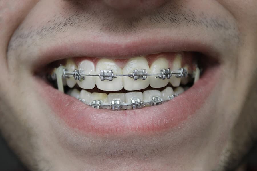 Clear Braces