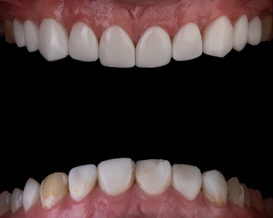 Laser Whitening