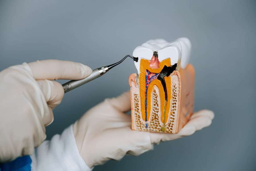 Root Canal
