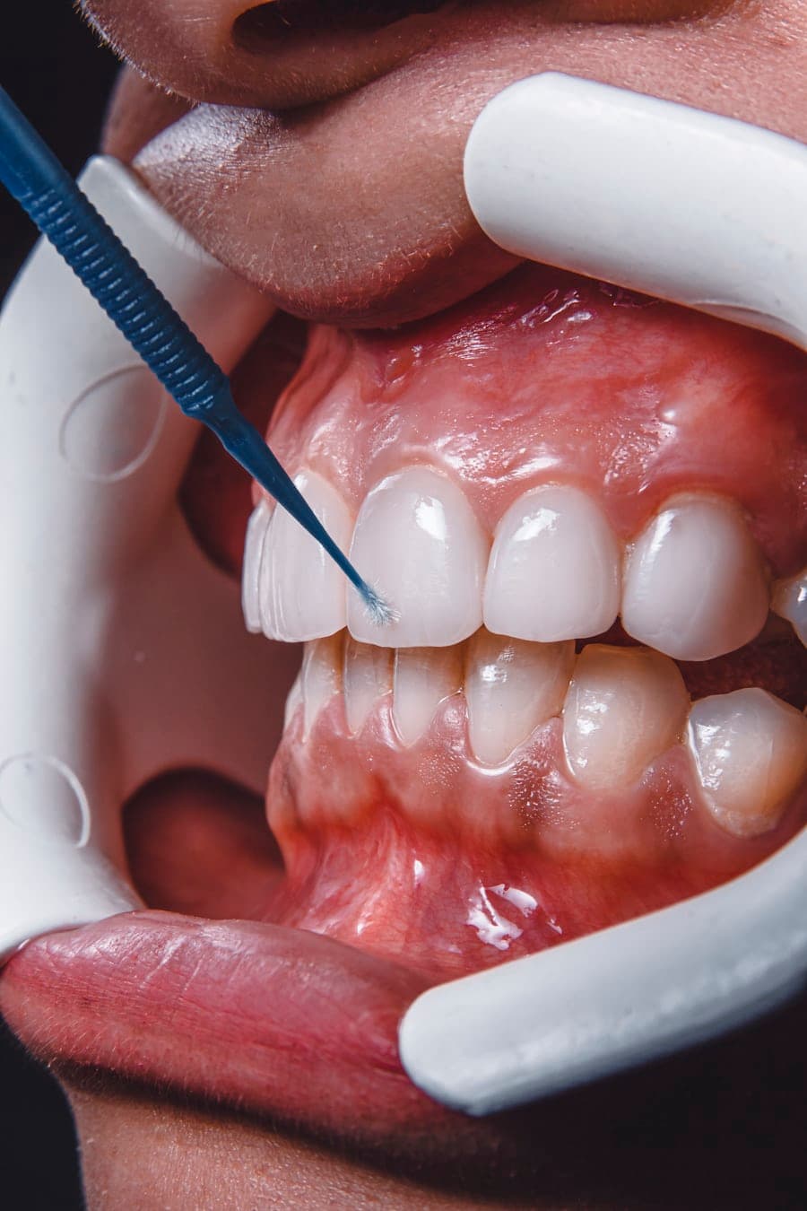 Teeth Cleaning