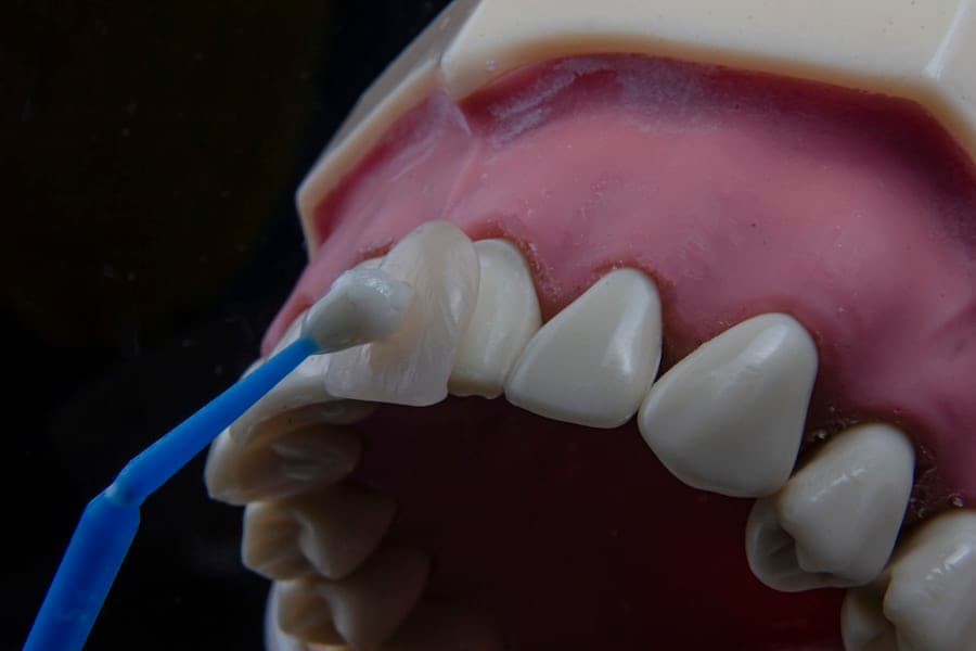 Veneers